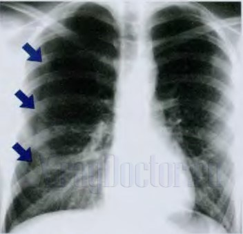 пневмоторакс на рентгенограмме
